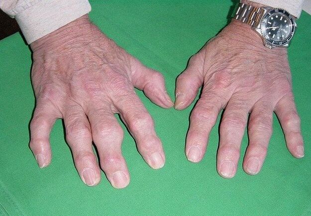 Osteoarthritis of the finger