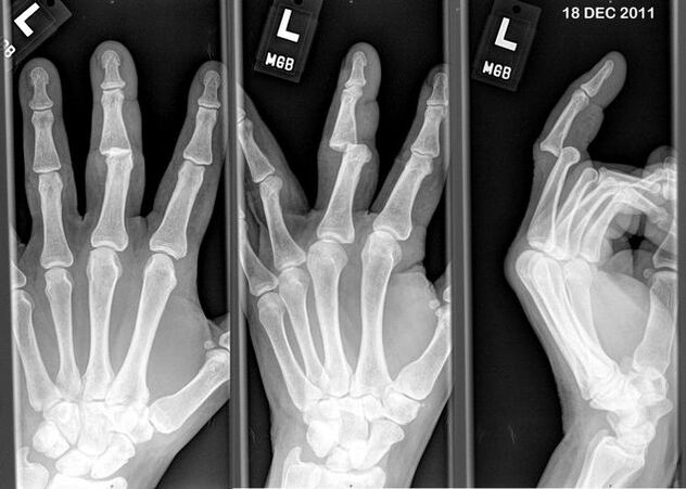 X-ray of the dislocated finger
