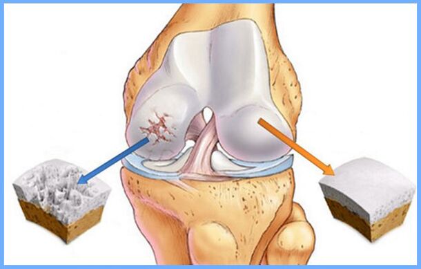 Knee joint that is normal and affected by arthropathy