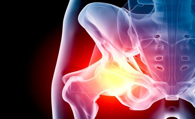 hip arthritis