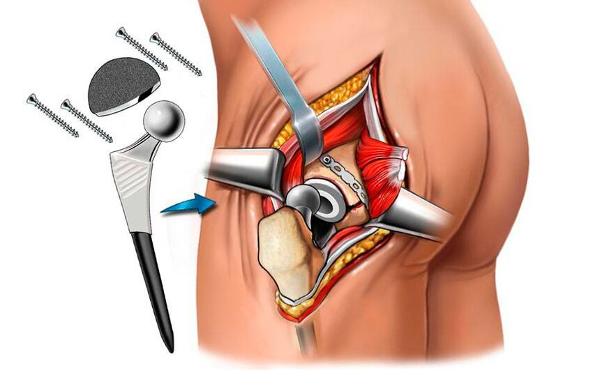 Endocrine installation - a surgical solution to the problem of coxarthrosis