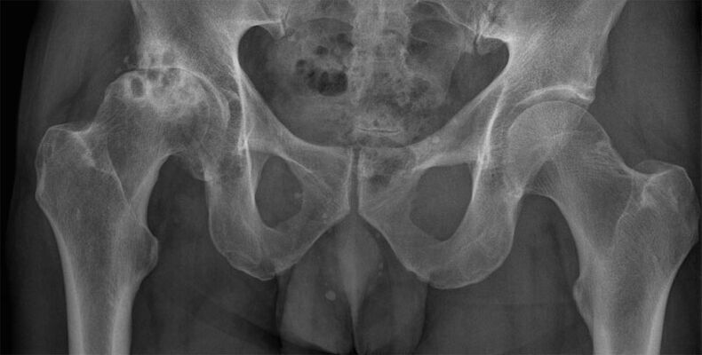 Hip deformity on X-ray film