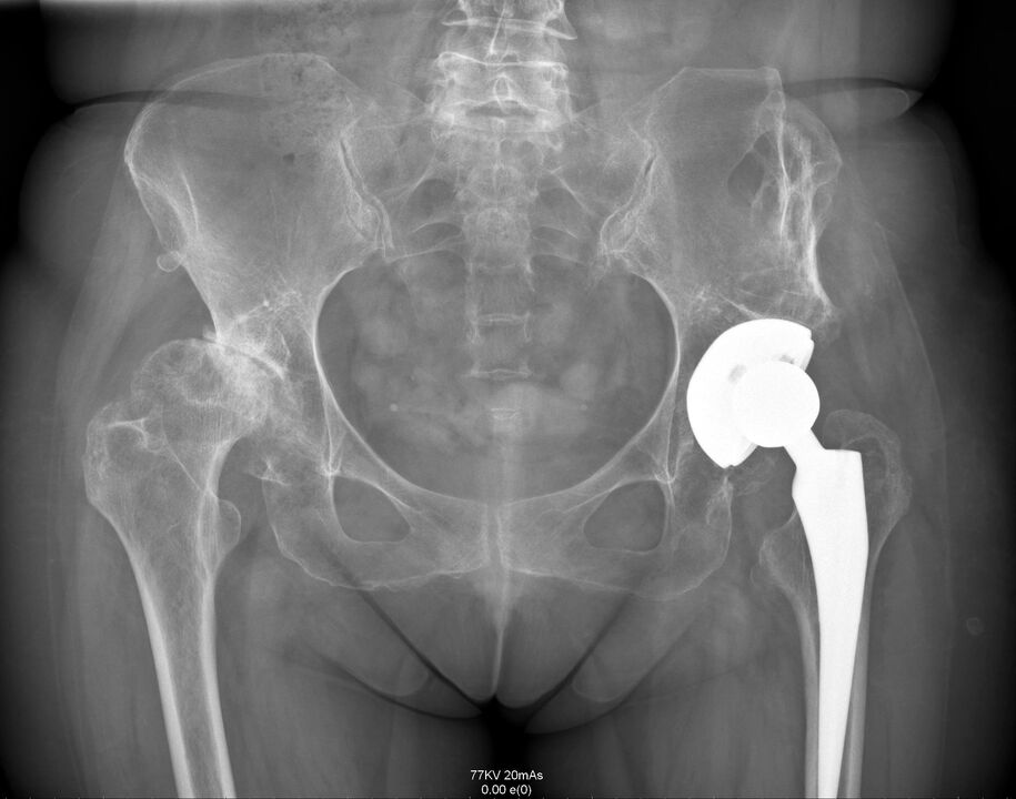 X-ray of hip joint after arthroplasty