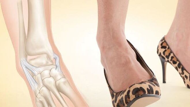 Wearing high heels is the cause of ankle joint disease