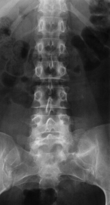 To diagnose lumbar osteoarthritis, x-rays are performed