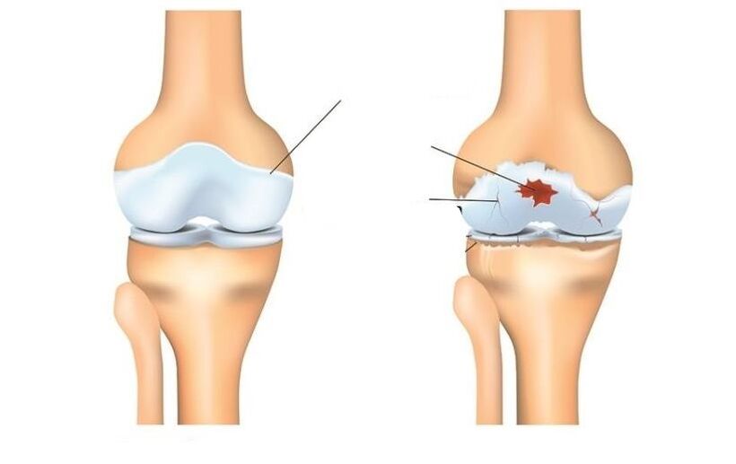 Healthy and patient with joints