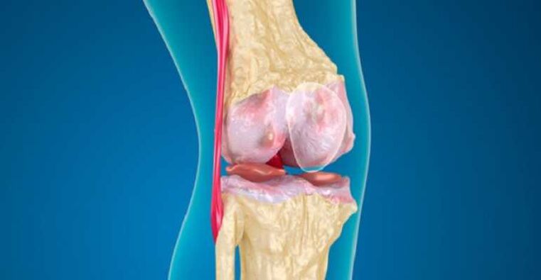 Knee arthritis, causing cartilage destruction in joints