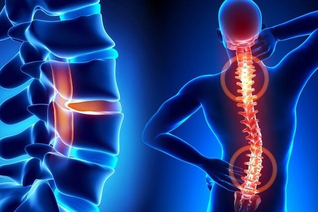 Degeneration of the spine