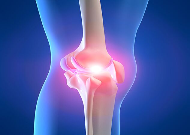 Joint pain due to knee arthritis
