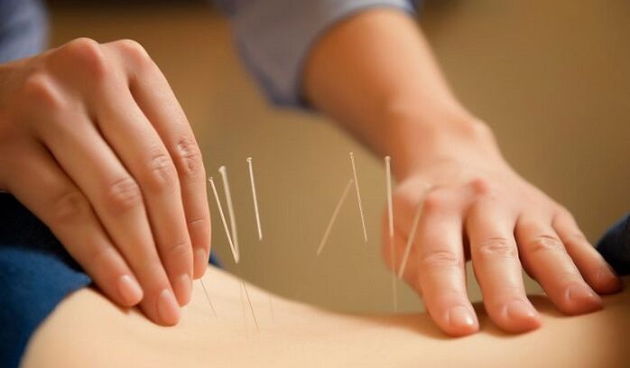 Acupuncture to treat low back pain