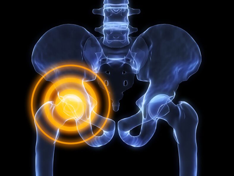 hip arthritis