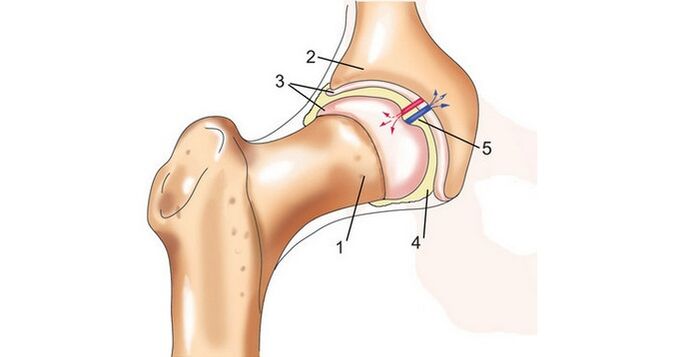 hip joints and arthritis