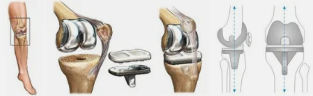 Endoprosthesis of the knee example
