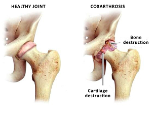 comparison of a healthy joint hip susta in